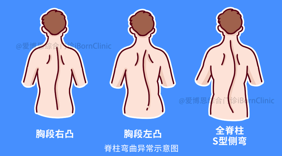 形成一个带有弧度的脊柱畸形,通常还伴有脊柱的旋转和矢状面上后突或